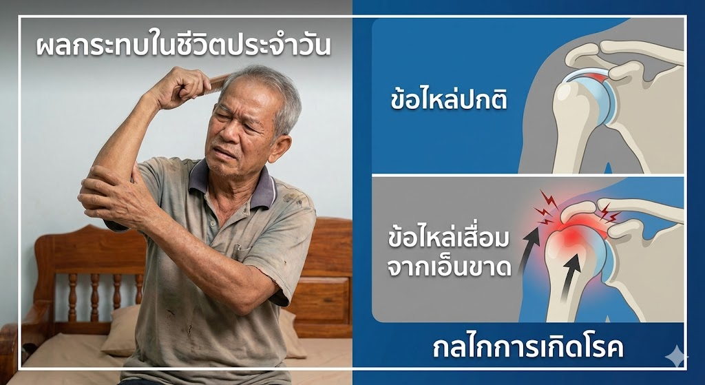 เอ็นไหล่ขาด... ปล่อยไว้ไม่รักษา นานไปจะกลายเป็น "ข้อไหล่เสื่อม" จริงไหม?