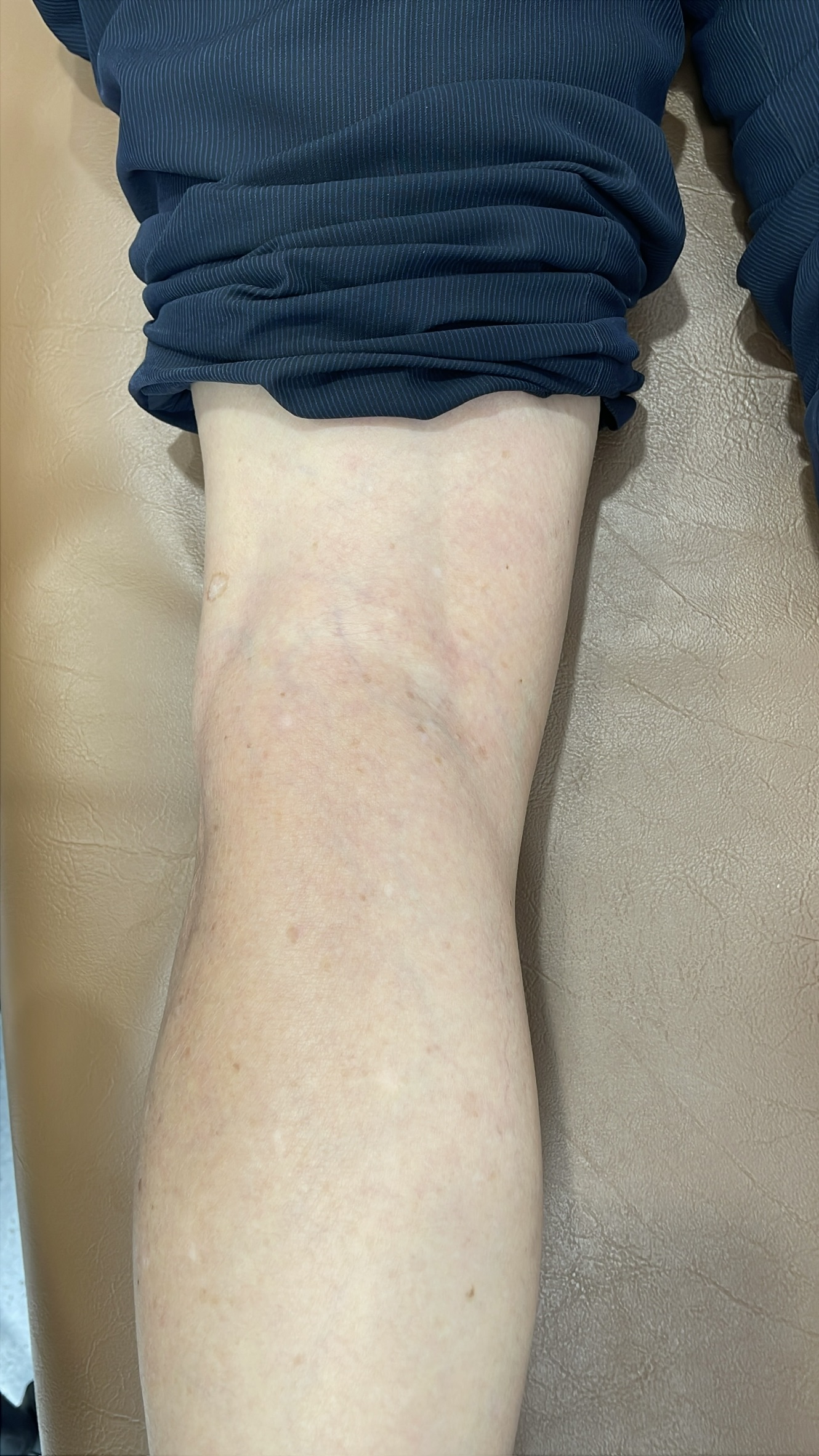 ถุงน้ำหลังเข่า (Baker's Cyst) : ก้อนปริศนาหลังข้อพับ อันตรายแค่ไหน ต้องผ่าตัดหรือไม่?