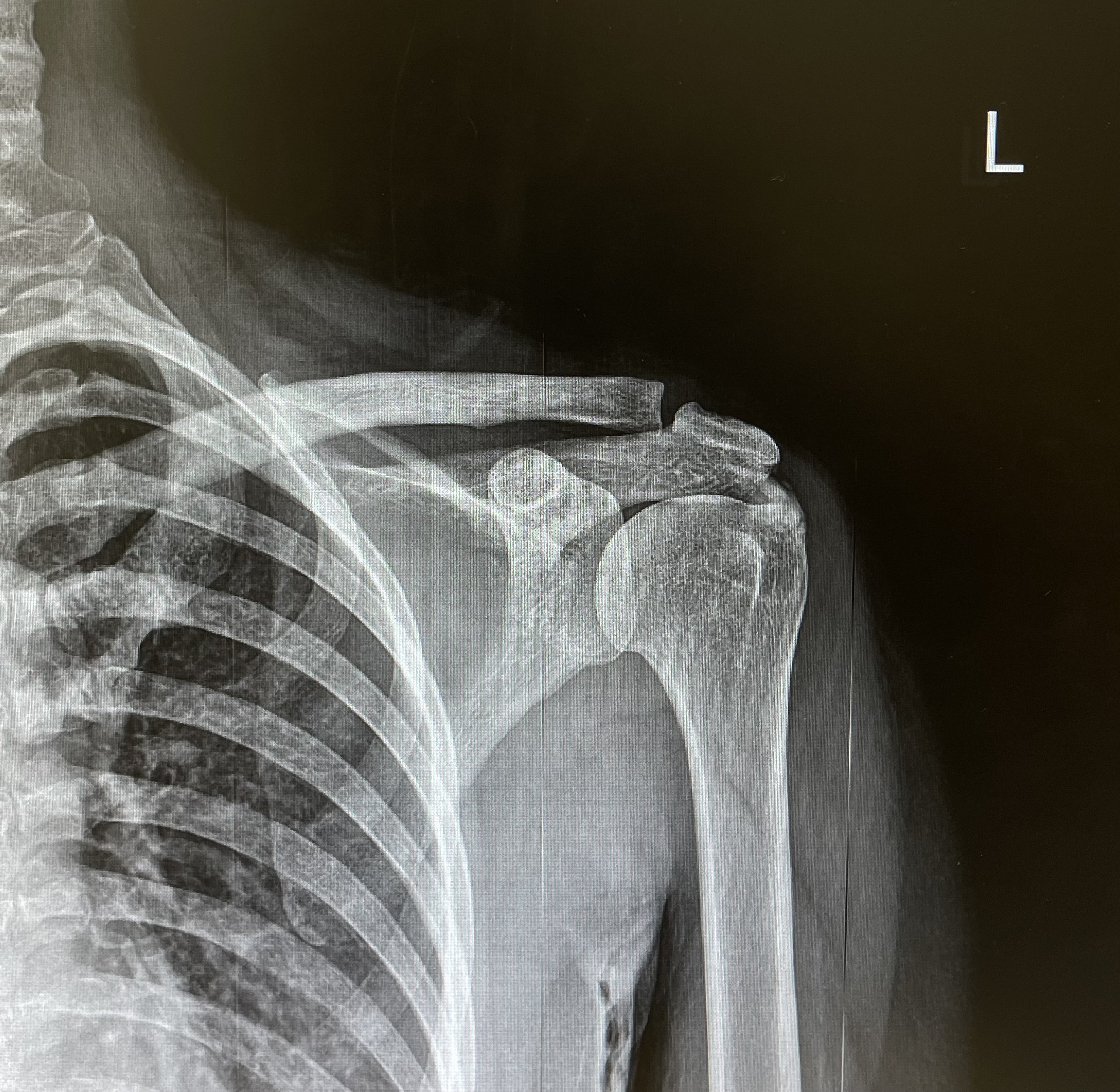 ปวดไหล่นรกแตกตอนตี 2? อาจไม่ใช่ผีอำ แต่เป็น "Calcific Tendinitis" มารู้จักโรคนี้กัน