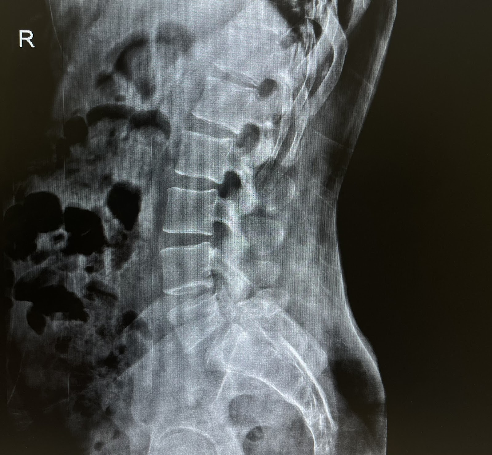 ปวดหลังเหมือนกัน... แต่ความอันตรายต่างกัน! "Spondylolysis" (รอยร้าว) vs "Spondylolisthesis" (รอยเลื่อน) . คุณกำลังเป็นแบบไหน?