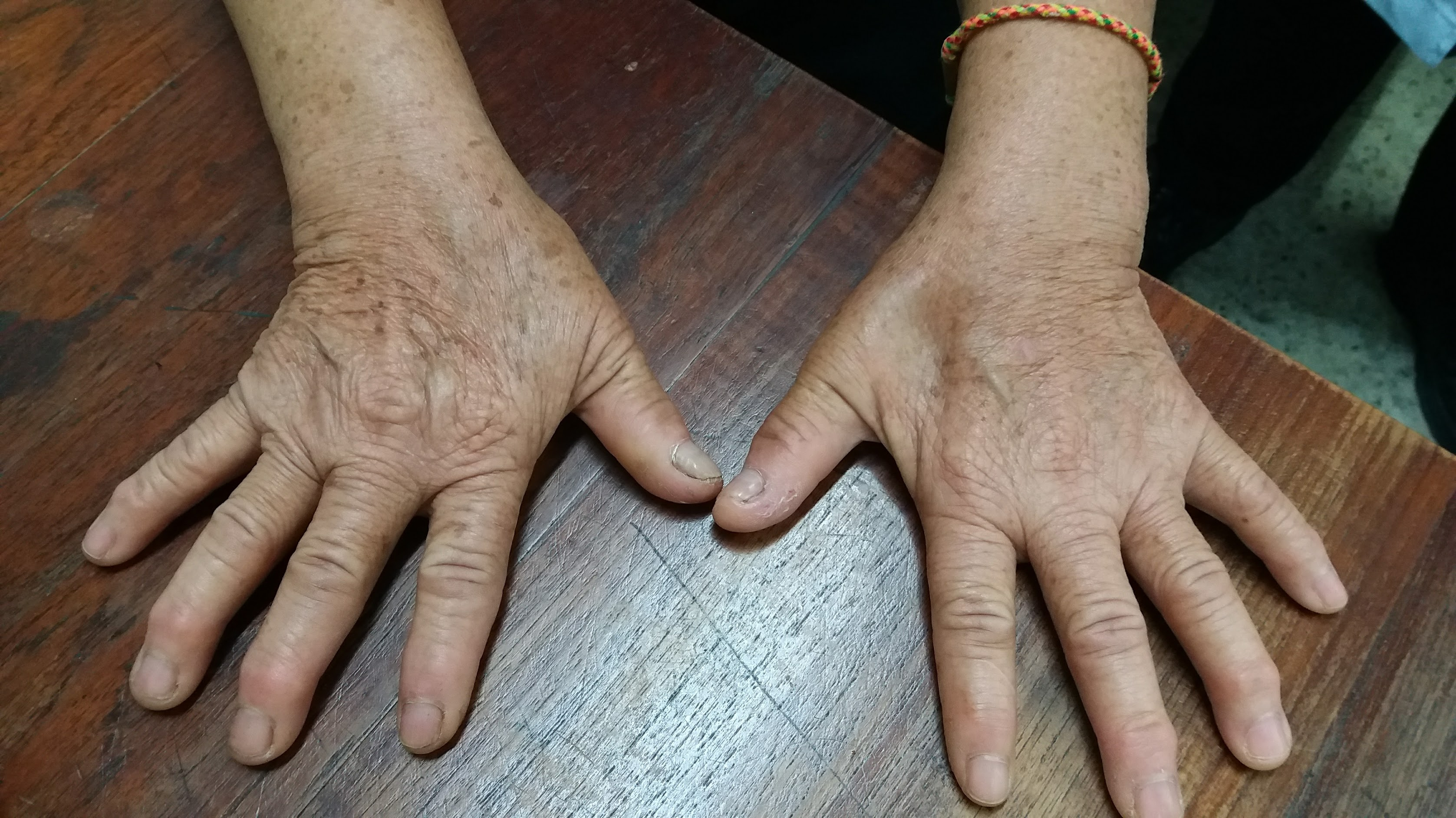 นิ้วโป่ง ข้อปูด กำมือไม่ลง... คุณกำลังเป็น "ข้อนิ้วมือเสื่อม" อยู่หรือเปล่า?