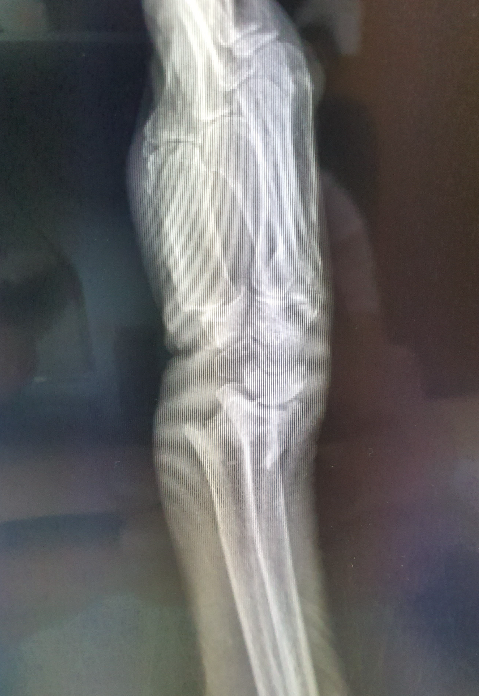 แค่ล้มเอามือยันพื้น... ทำไมกระดูกถึงหักง่ายจัง?" สัญญาณเตือนภัยเงียบ ของผู้หญิงวัย 50+ ที่ไม่ควรมองข้าม!