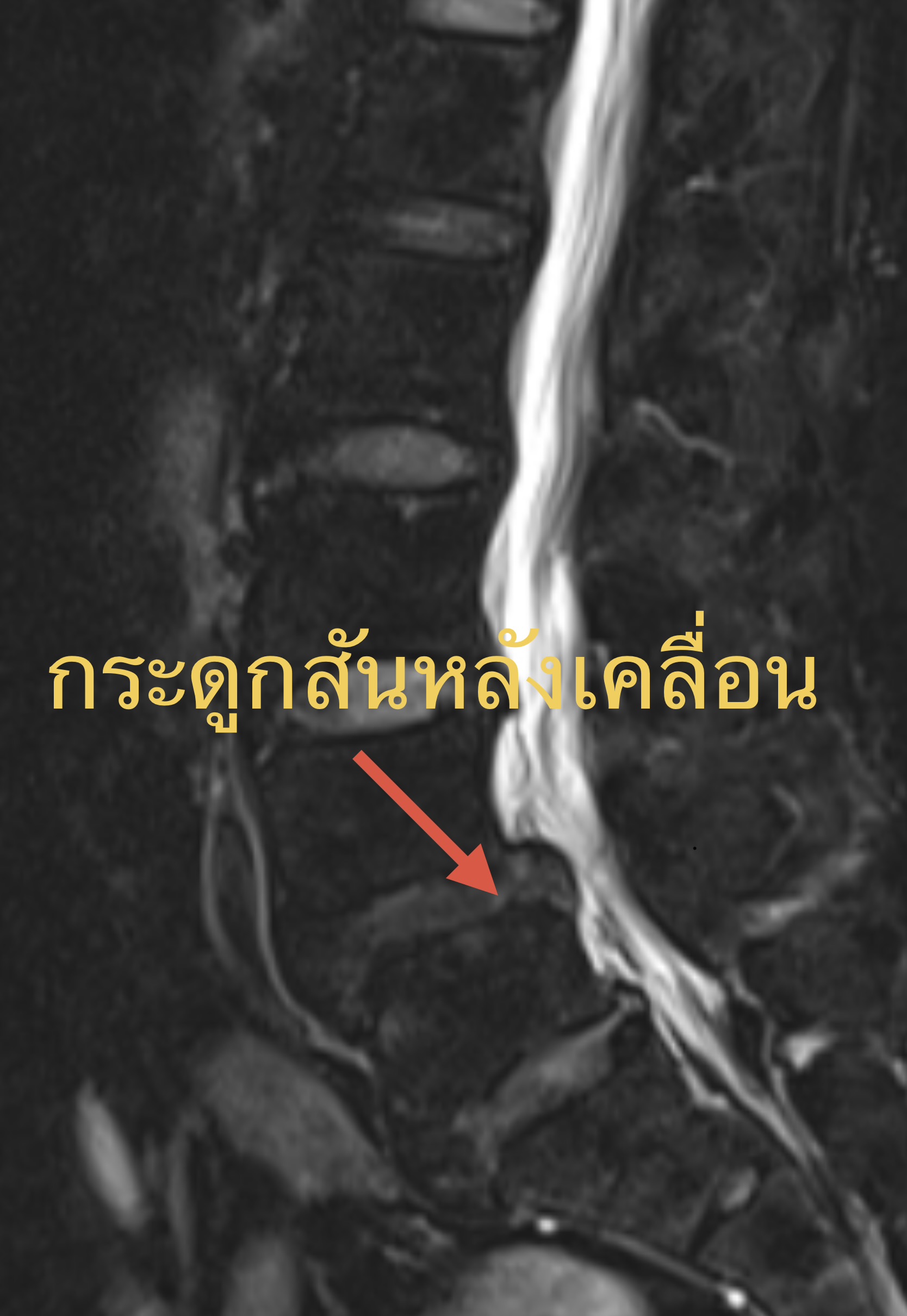 แค่ก้มเก็บของแต่เหมือนไฟช็อตลงขา! "กระดูกสันหลังเคลื่อน" เรื่องใหญ่ที่คนปวดหลังต้องรู้