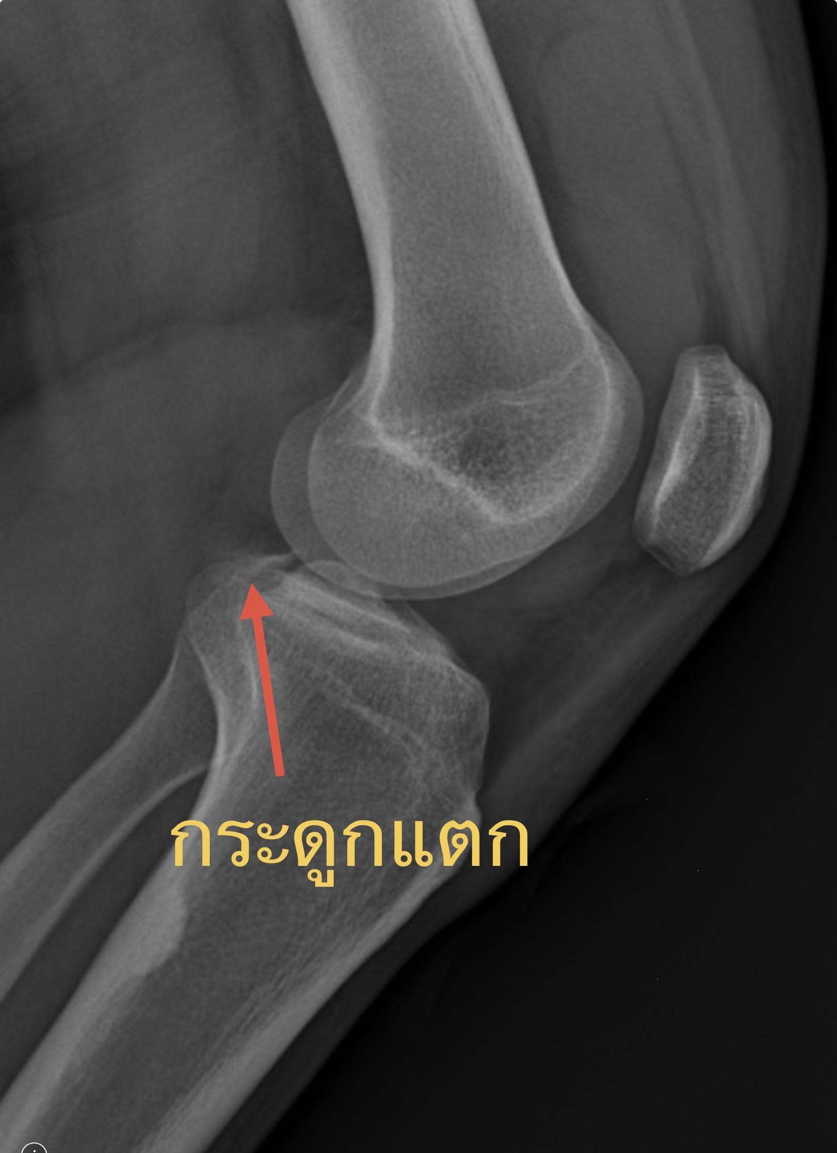 "เข่าพังหลังอุบัติเหตุ" แค่กระดูกกระชากหรือมีอะไรขาดข้างในอีก?