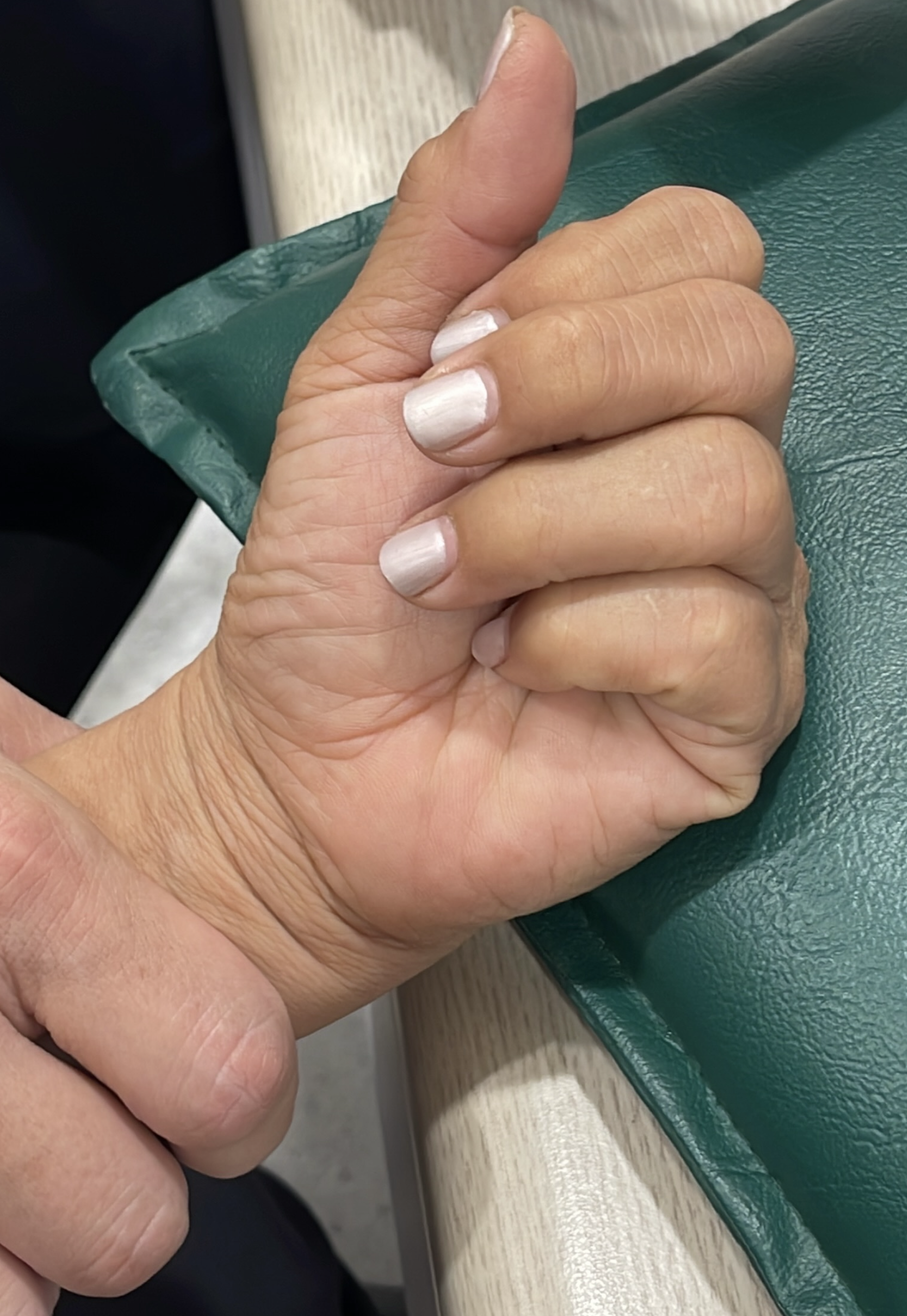 นิ้วติด ขยับไม่ได้ แค่ตื่นมาก็ง้างไม่ออก" หลายคนคิดว่าทางเดียวที่หายคือต้องผ่าตัดกรีดแผลยาวๆ... แต่ความจริงคือ เราใช้แค่ "รูเข็ม" เล็กๆ ก็รักษาให้หายได้ในไม่กี่นาที