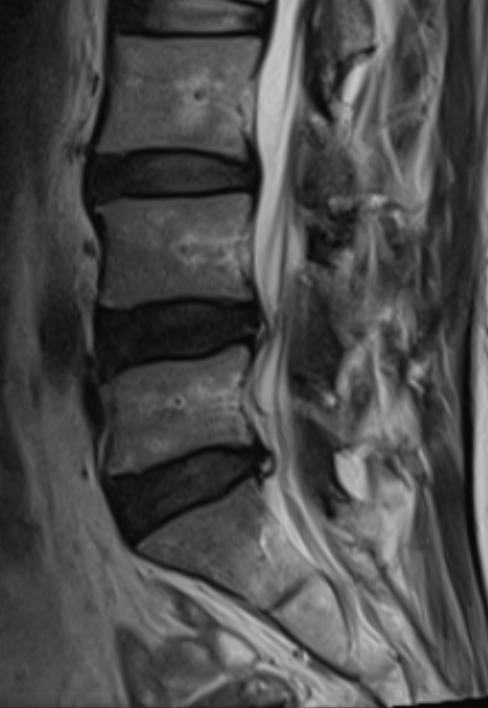 ทำไมผล MRI กับ "ความปวด" ถึงไม่ตรงกัน? ปวดแทบตายแต่หมออ่านว่า "นิดเดียว"