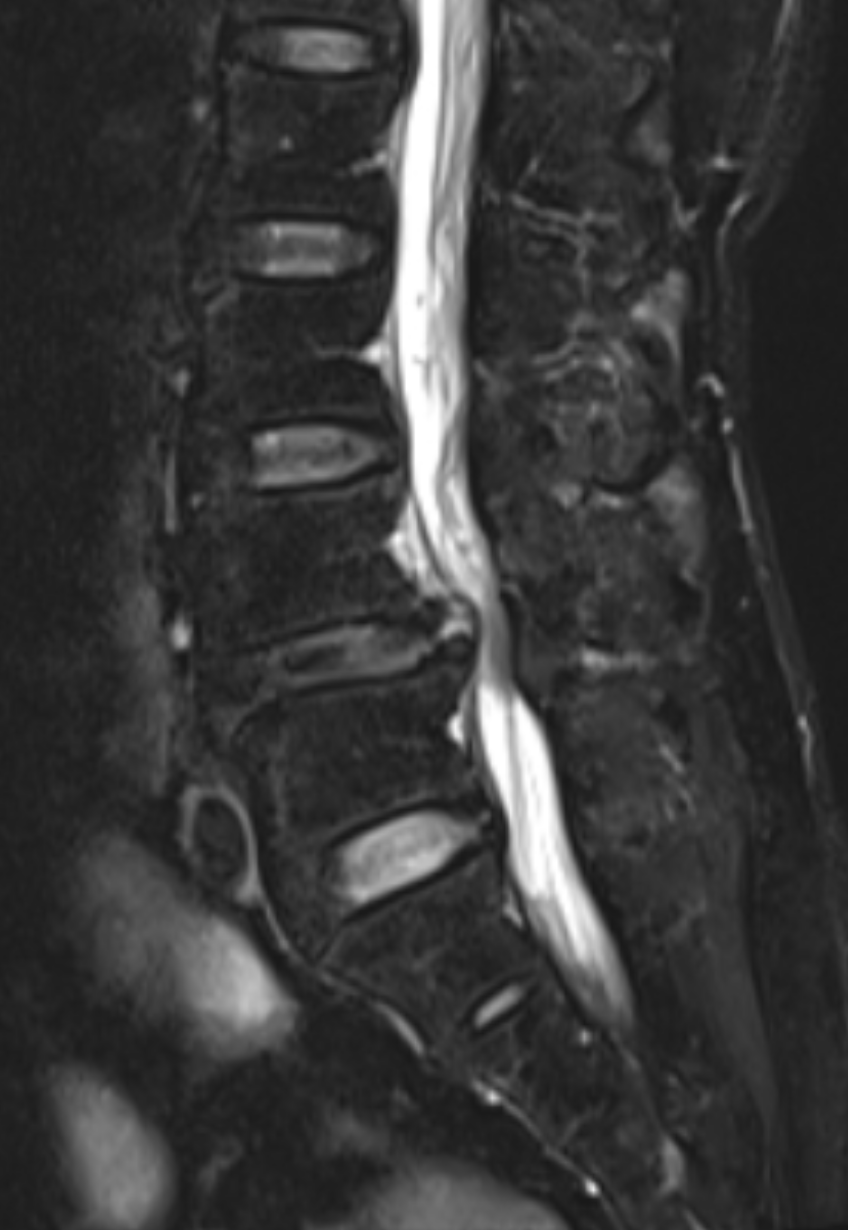 "เป็นหมอนรองกระดูกทับเส้น... ต้องผ่าตัดอย่างเดียวจริงหรือ? ไขข้อสงสัยกับ Fact ที่ว่า 90% หายได้โดยไม่ต้องใช้มีดผ่าตัด!