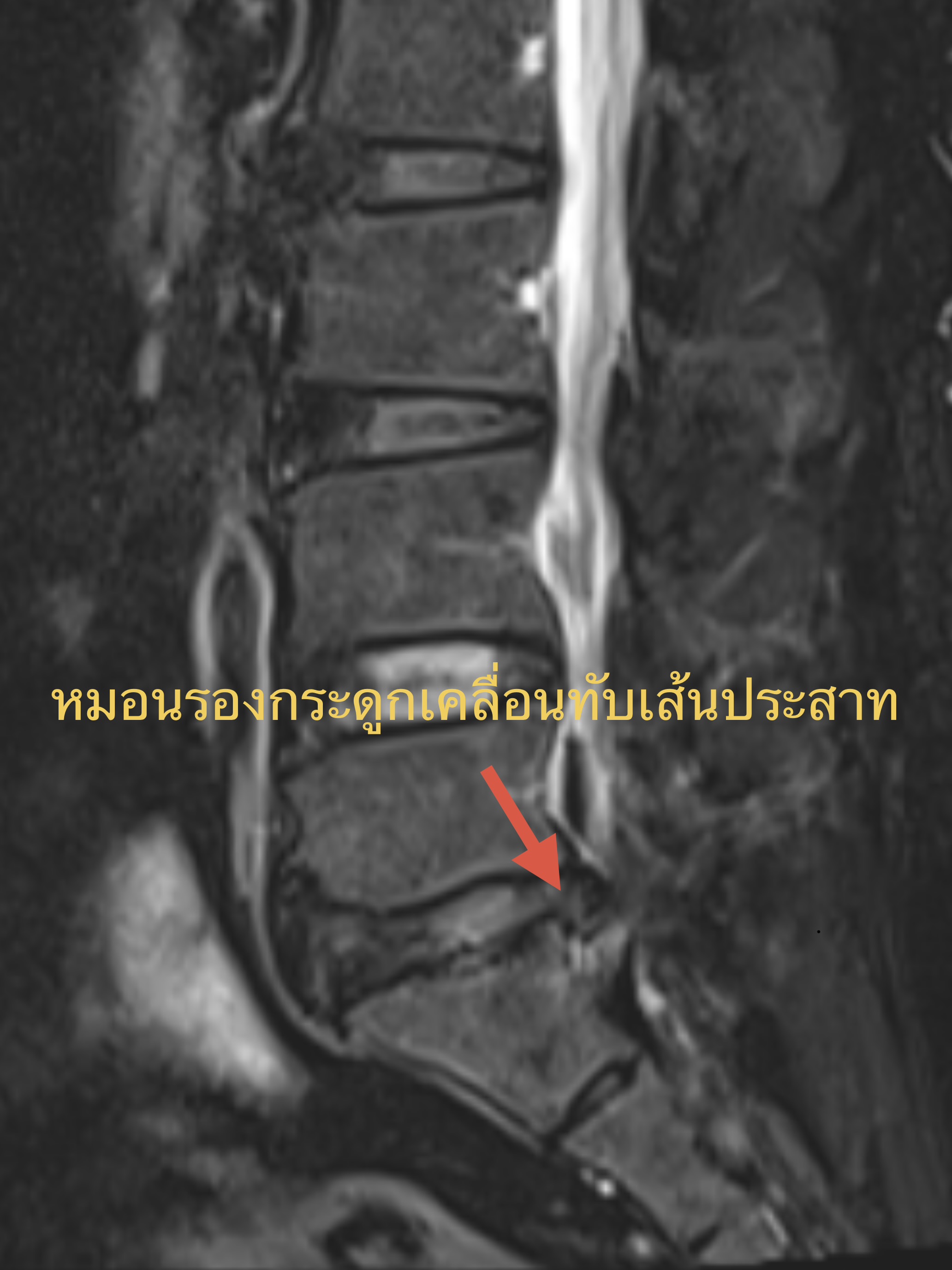 เจอภาพ MRI "หมอนรองกระดูกทับเส้น" แต่ทำไมไม่ค่อยปวด... ต้องรีบผ่าไหม?