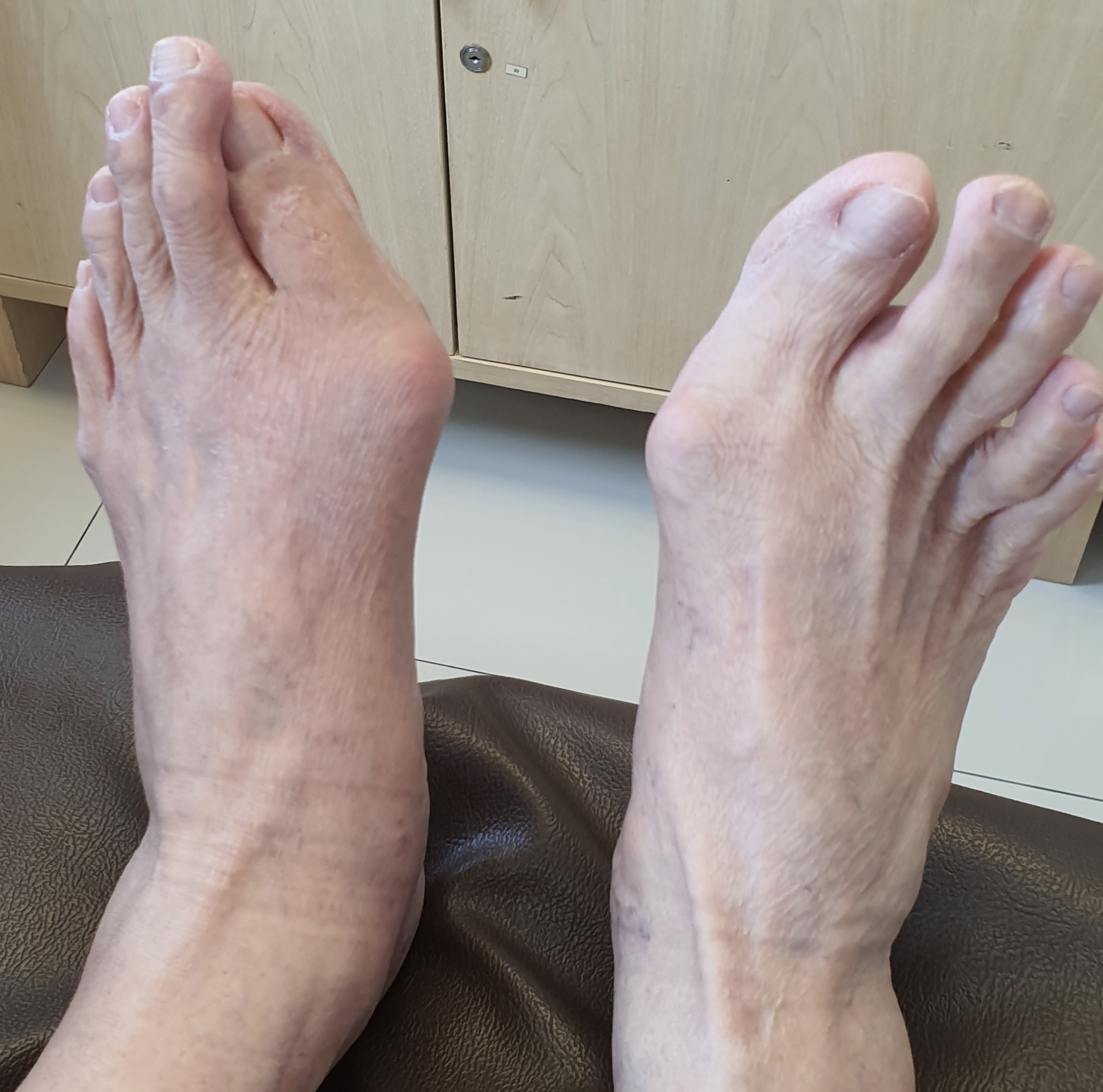 นิ้วหัวแม่เท้าเก (Hallux Valgus)... ปล่อยไว้จะพังทั้งเท้า! ต้อง "ผ่าตัด" อย่างเดียวถึงจะหายไหม?