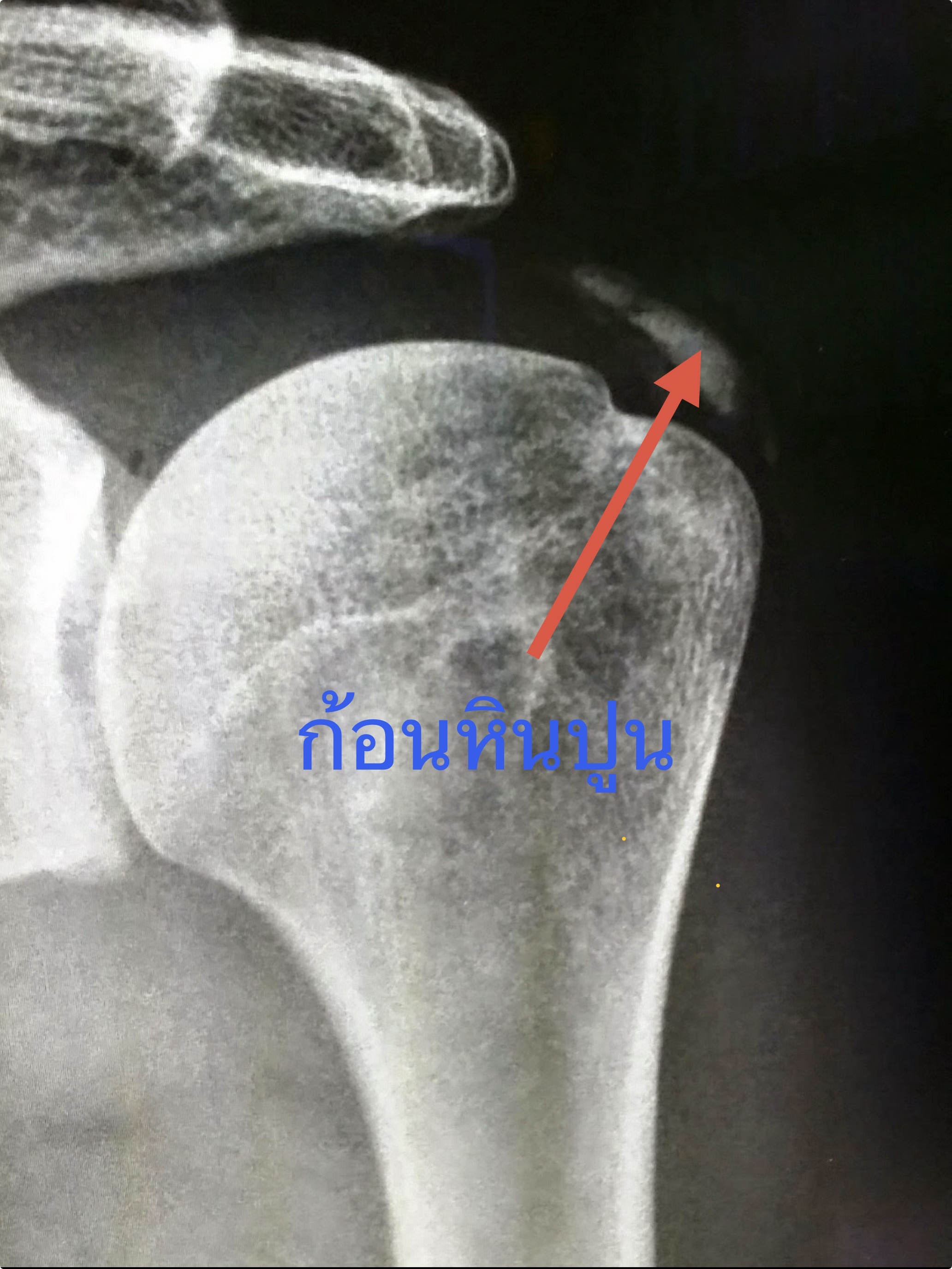 หินปูนเกาะเส้นเอ็นไหล่ ไม่ต้องผ่าตัดก็รักษาได้จริงหรือ?”