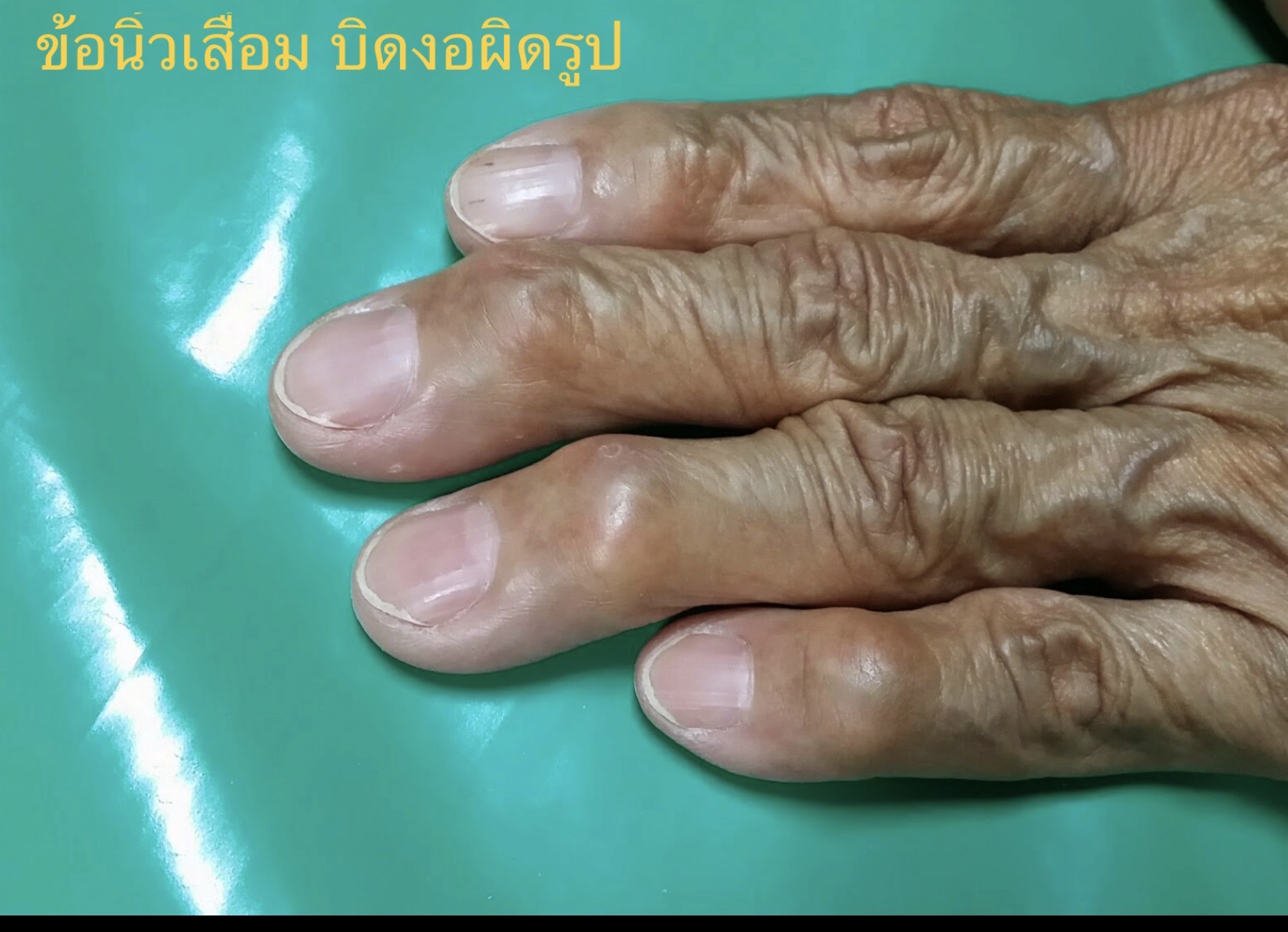 นิ้วแข็งตอนเช้า กำมือไม่ลง.