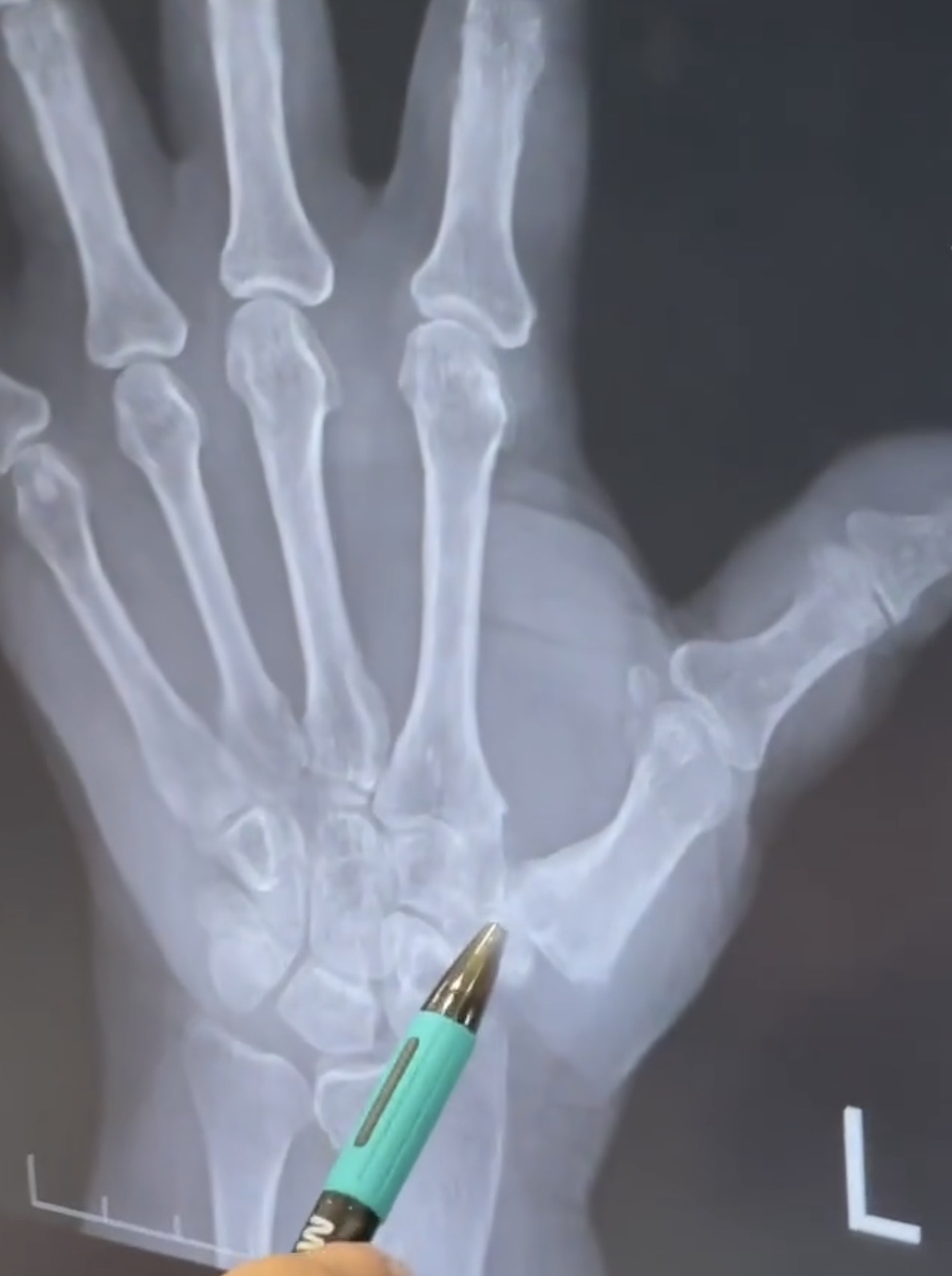 นิ้วหัวแม่มือขัด ปวดโคนนิ้วหยิบจับอะไรก็ลำบาก... สัญญาณเตือน "ข้อโคนนิ้วหัวแม่มือเสื่อม" ที่คนวัยทำงานและผู้สูงอายุควรรู้