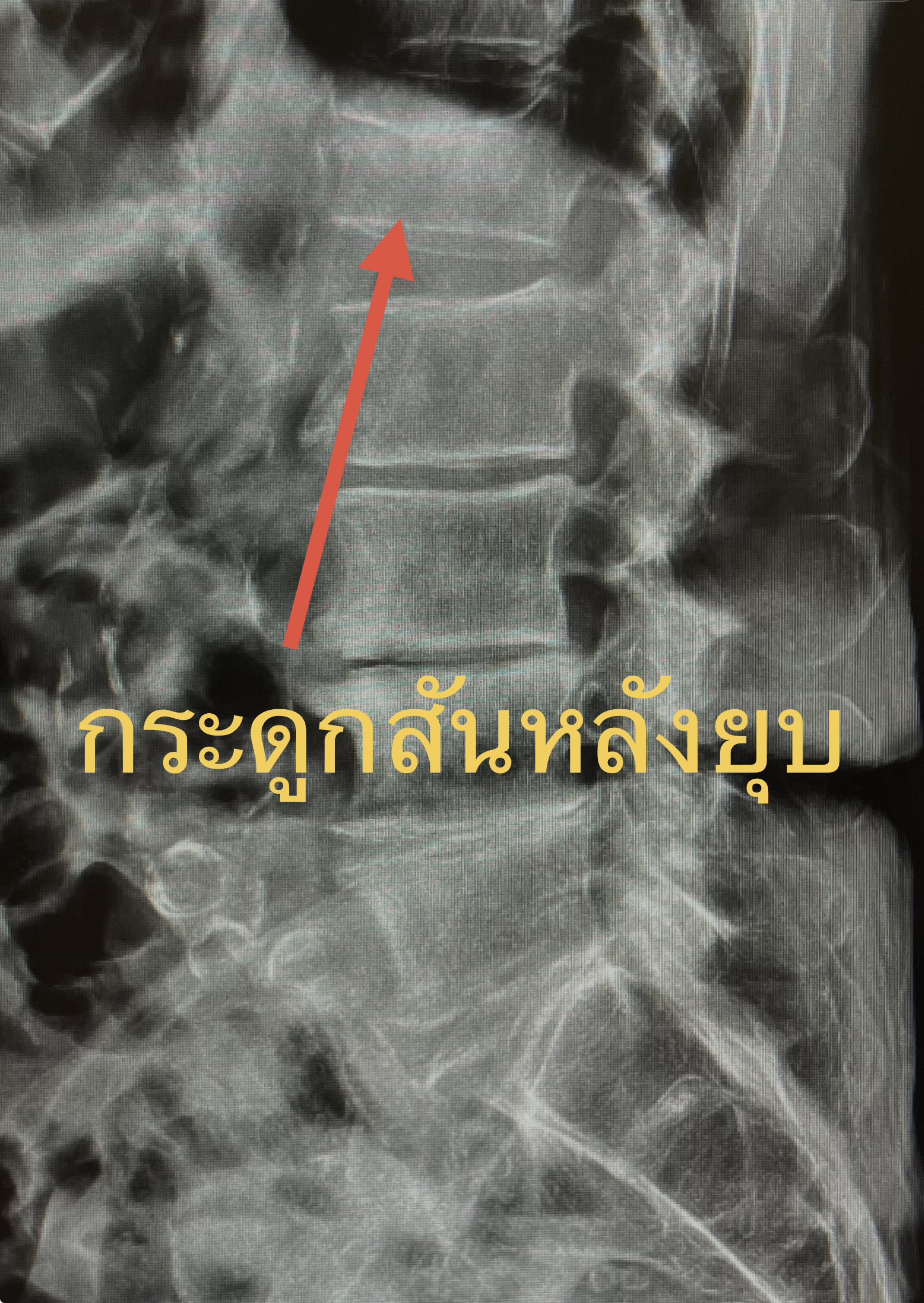 หกล้มหงายหลัง... ปวดหลังรุนแรงจนลุกไม่ไหว สัญญาณ "กระดูกสันหลังยุบ" ในวัย 75 ปี