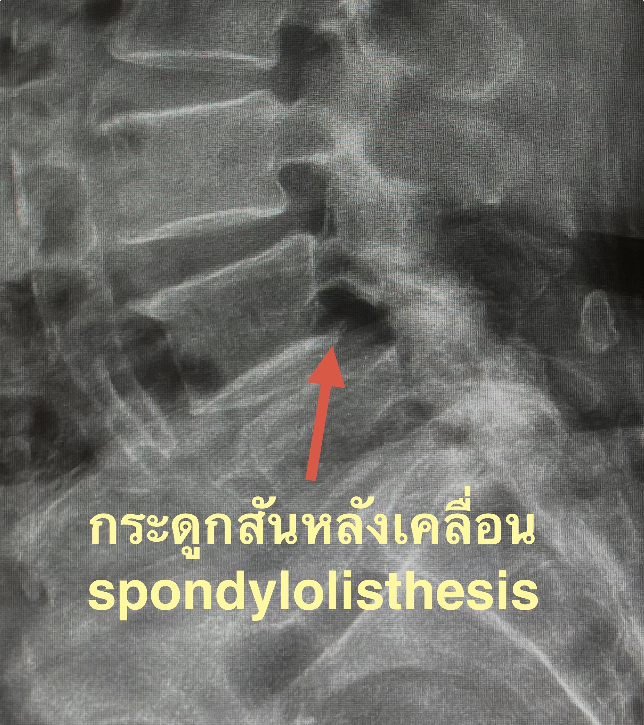 ปวดหลังร้าวลงก้นกบ... แค่กระดูกเสื่อมตามวัย หรือ "กระดูกสันหลังเคลื่อน" จนทับเส้นประสาท?