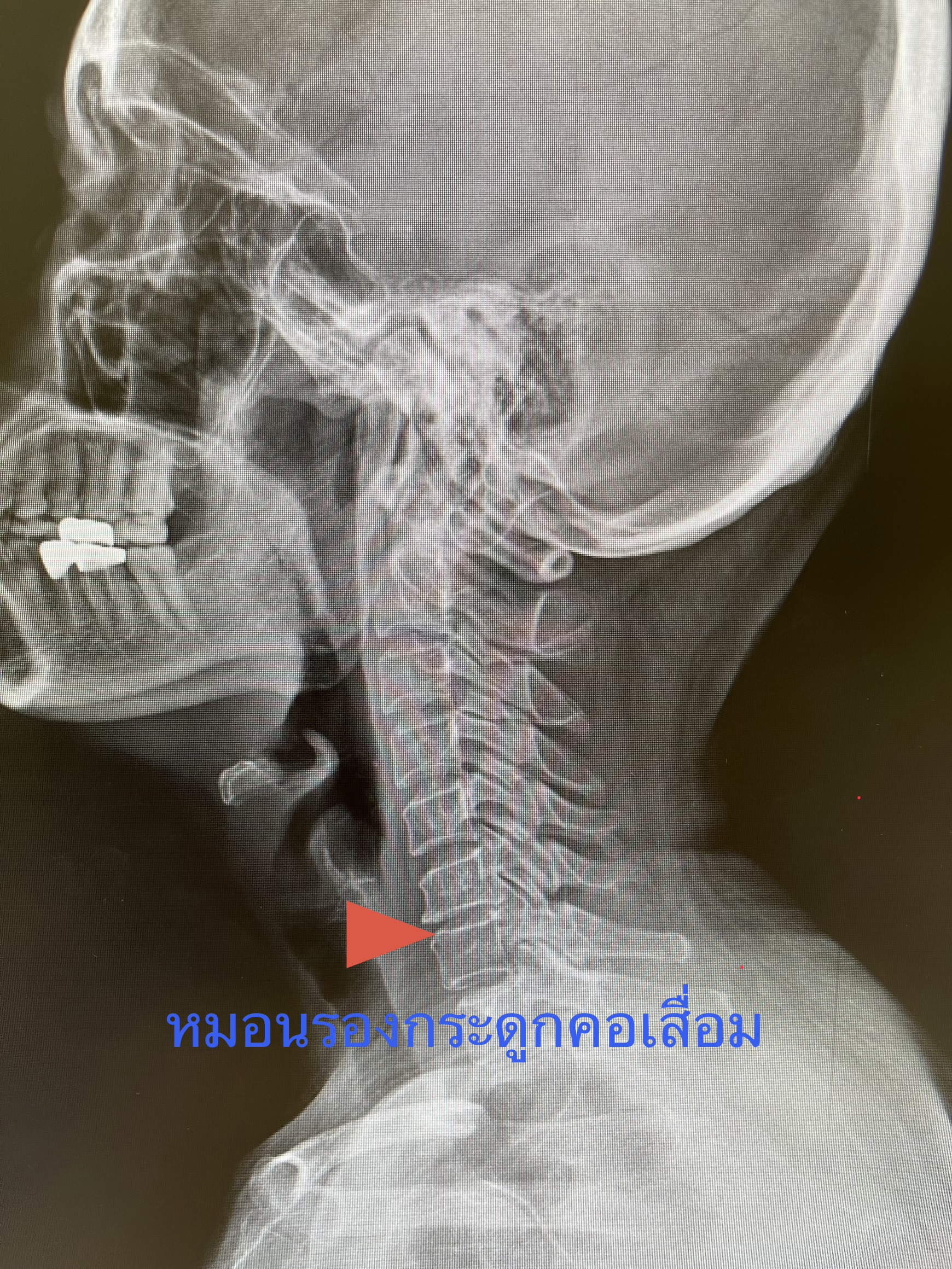 ปวดคอร้าวลงสะบัก ชาลงแขน... สัญญาณ "หมอนรองกระดูกคอเสื่อม" ที่ผู้หญิงวัย 55 ต้องรู้