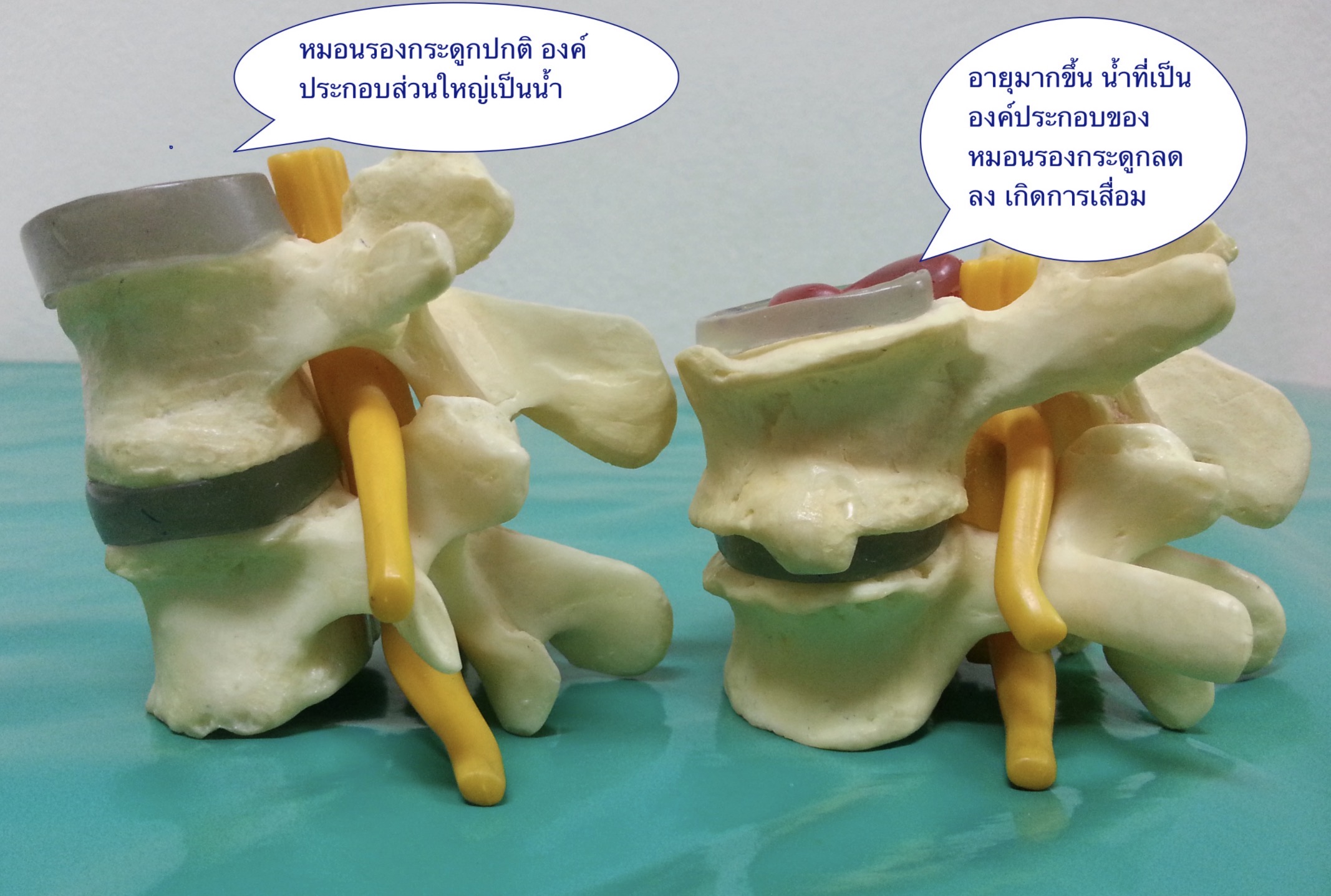 กระดูกเสื่อม vs หมอนรองกระดูกเสื่อม กินอะไรให้กลับมาเหมือนเดิมได้จริงหรือ?