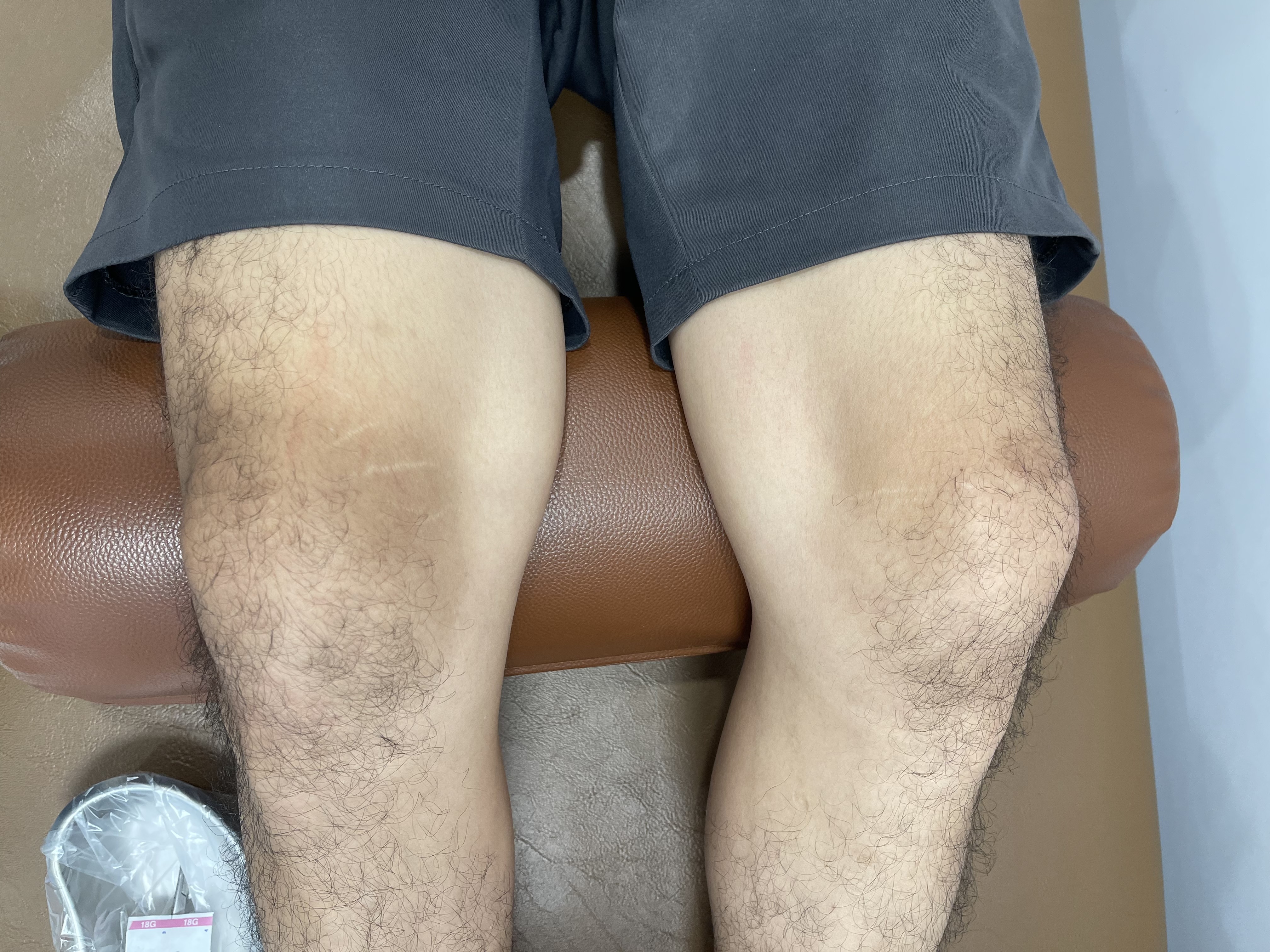 ปวดเข่าบวม ปวดข้อเท้าทั้งสองข้าง อายุแค่ 35 ปี… ไม่ใช่แค่ "เมื่อย" แต่อาจเป็นสัญญาณที่ต้องรีบตรวจ