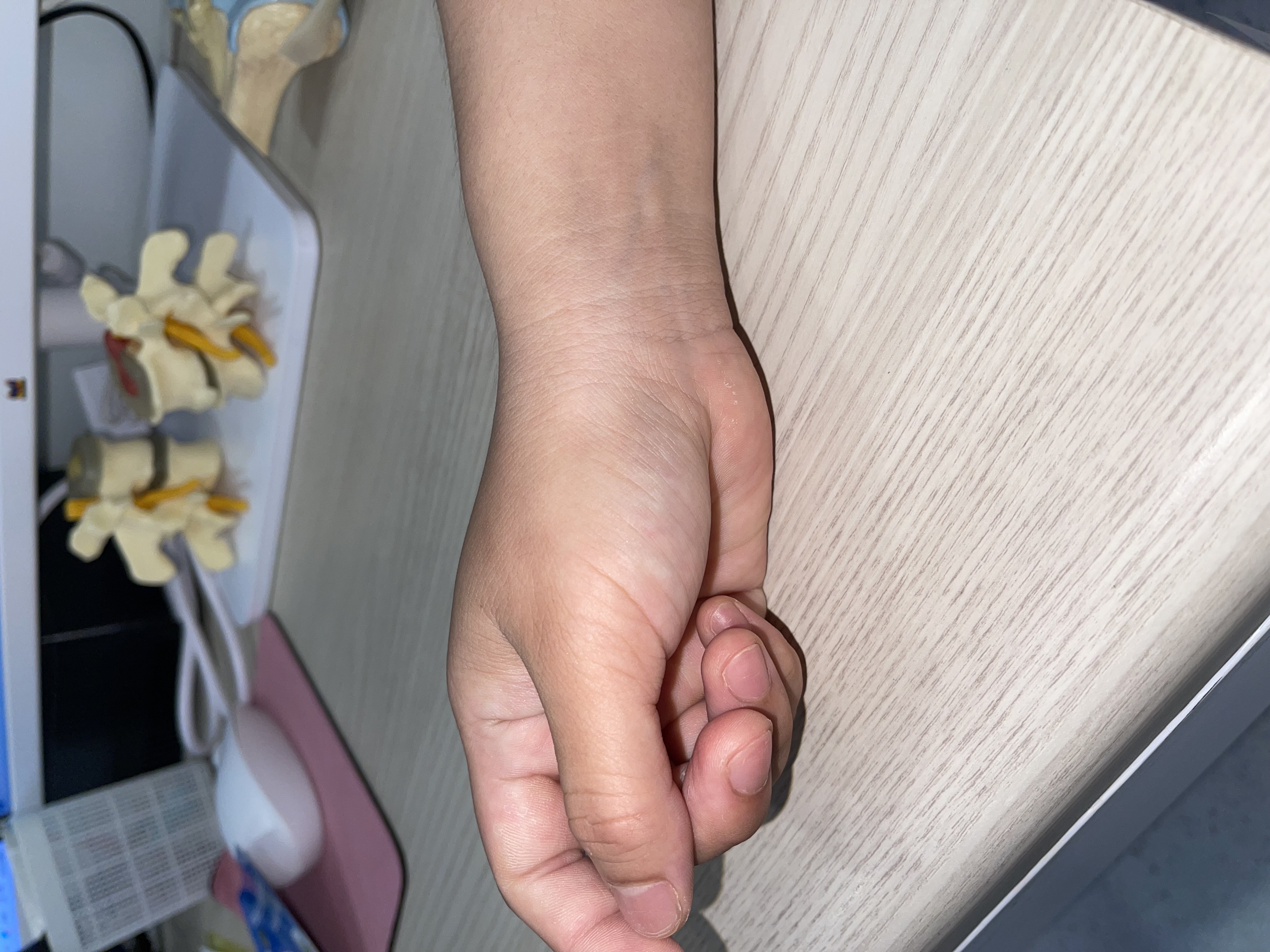 ปวดข้อมือฝั่งนิ้วโป้ง อย่ามองข้าม รู้จัก "โรค De Quervain" และทางออกใหม่ที่ไม่ต้องผ่าตัด