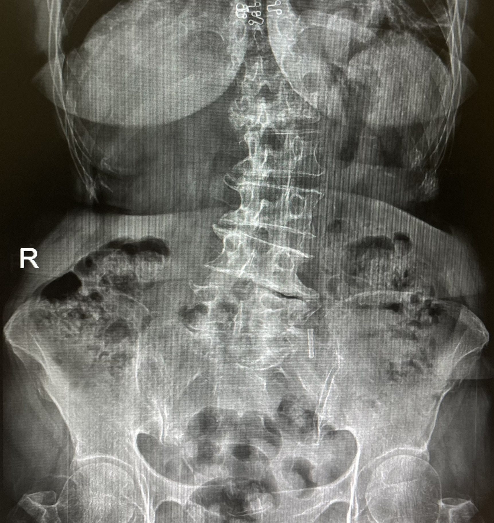 กระดูกสันหลังคดในผู้สูงอายุ ปวดหลังร้าวลงขา รักษาได้โดยไม่ต้องผ่าตัด ด้วย Ultrasound-Guided Epidural Injection