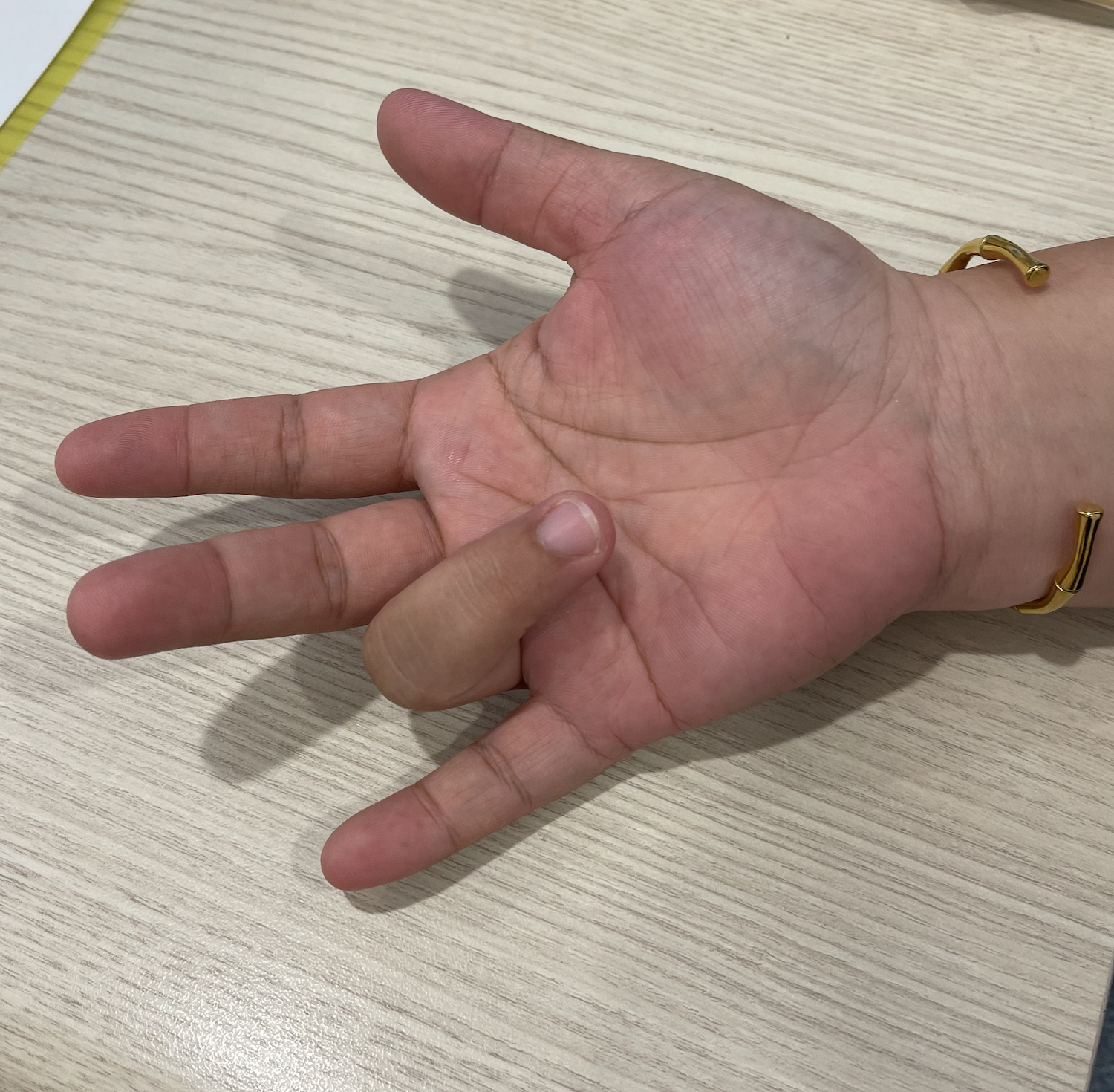 นิ้วล็อค คลายได้ด้วยปลายเข็ม ไม่ต้องผ่าตัด ไม่ต้องเย็บแผล