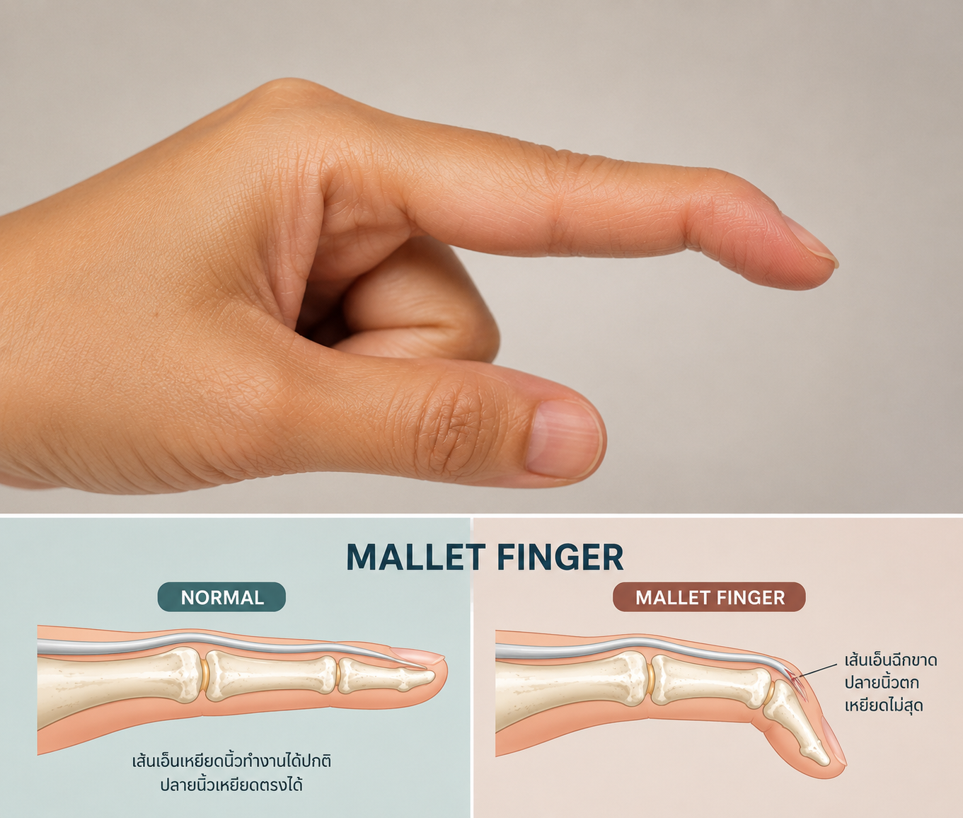 สิ่งสำคัญที่ต้องรู้ เมื่อเส้นเอ็นฉีกขาด Mallet finger 