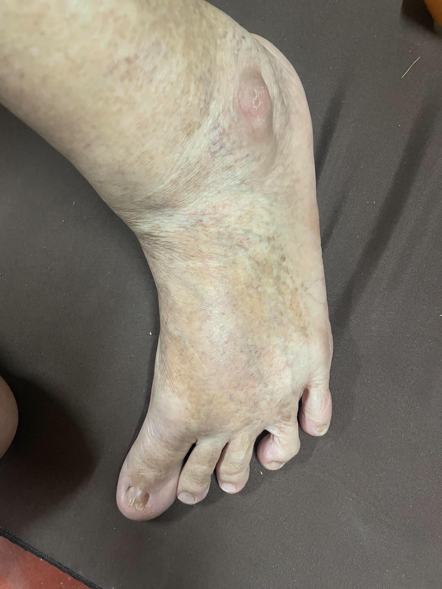 ทำไมเท้าหันเข้าใน และเมื่อไหร่คือเวลาที่ต้องพบแพทย์